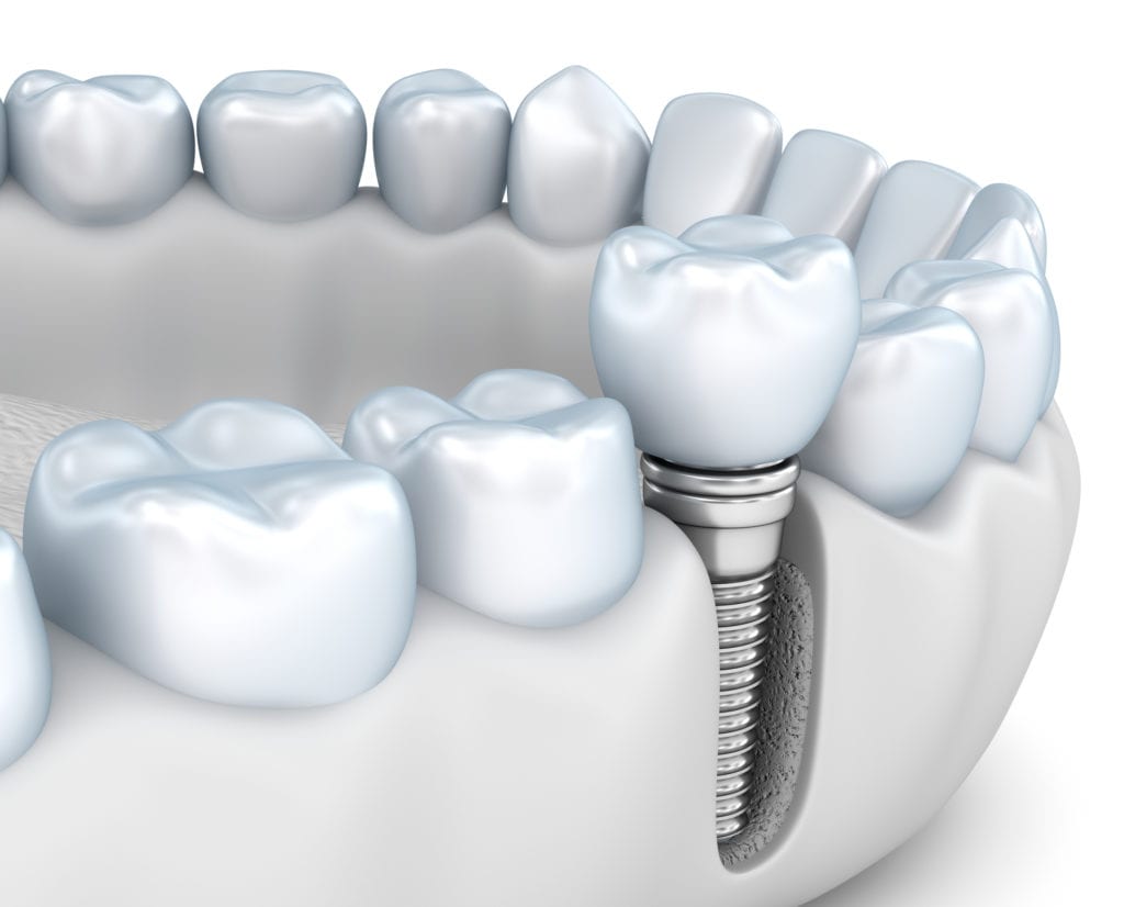 Affordable dental Implants in Laurel Maryland