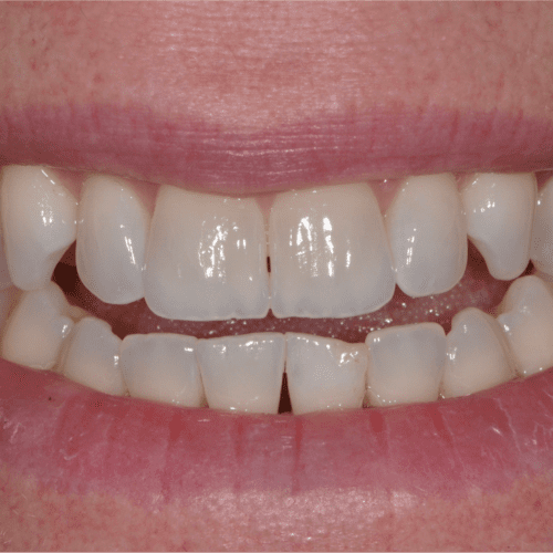 Before dental care in Laurel Maryland by Laurel Smiles Dental Care