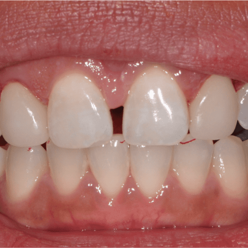 After dental care in Laurel Maryland by Laurel Smiles Dental Care