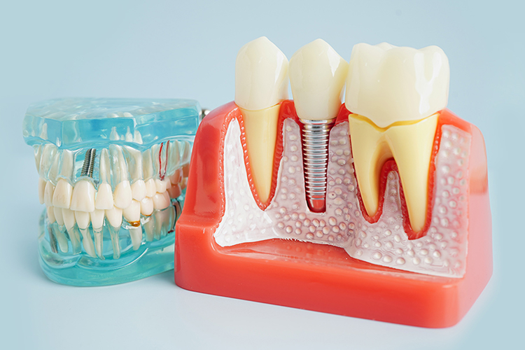 How Much Do Dental Implants Cost in Maryland