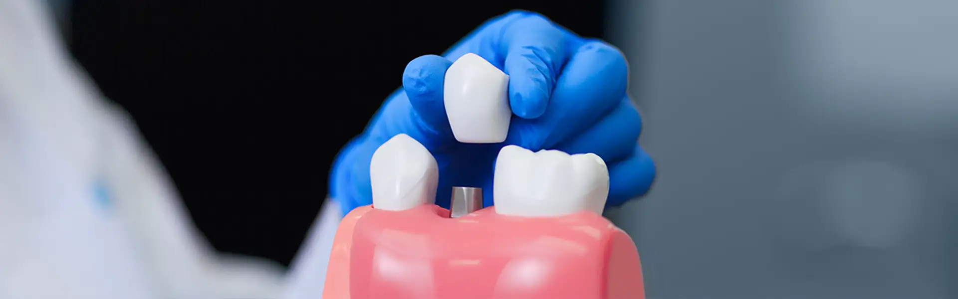 Dental implants
